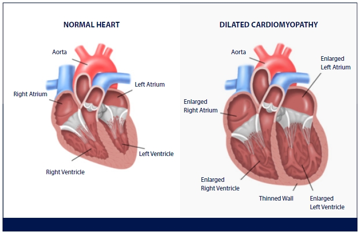 Dilated Cardiomyopathy